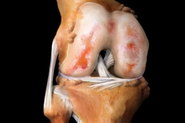 cartilage damage in knee osteoarthritis