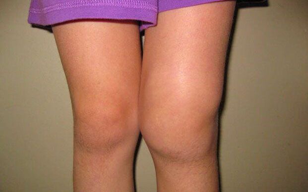 swollen knee due to osteoarthritis
