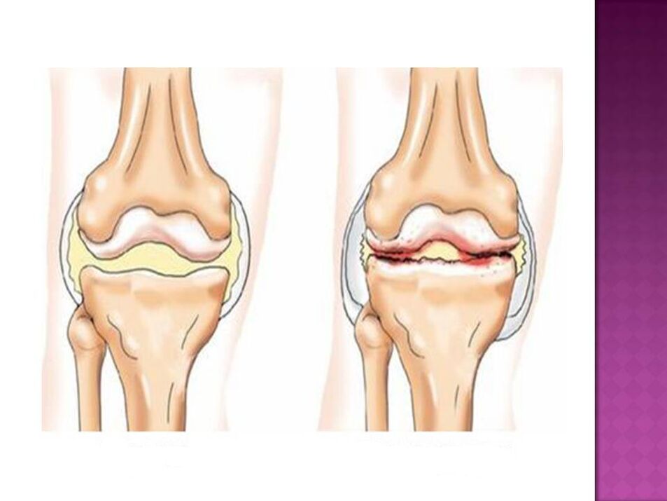 The joint is normal (left) and affected by osteoarthritis (right)