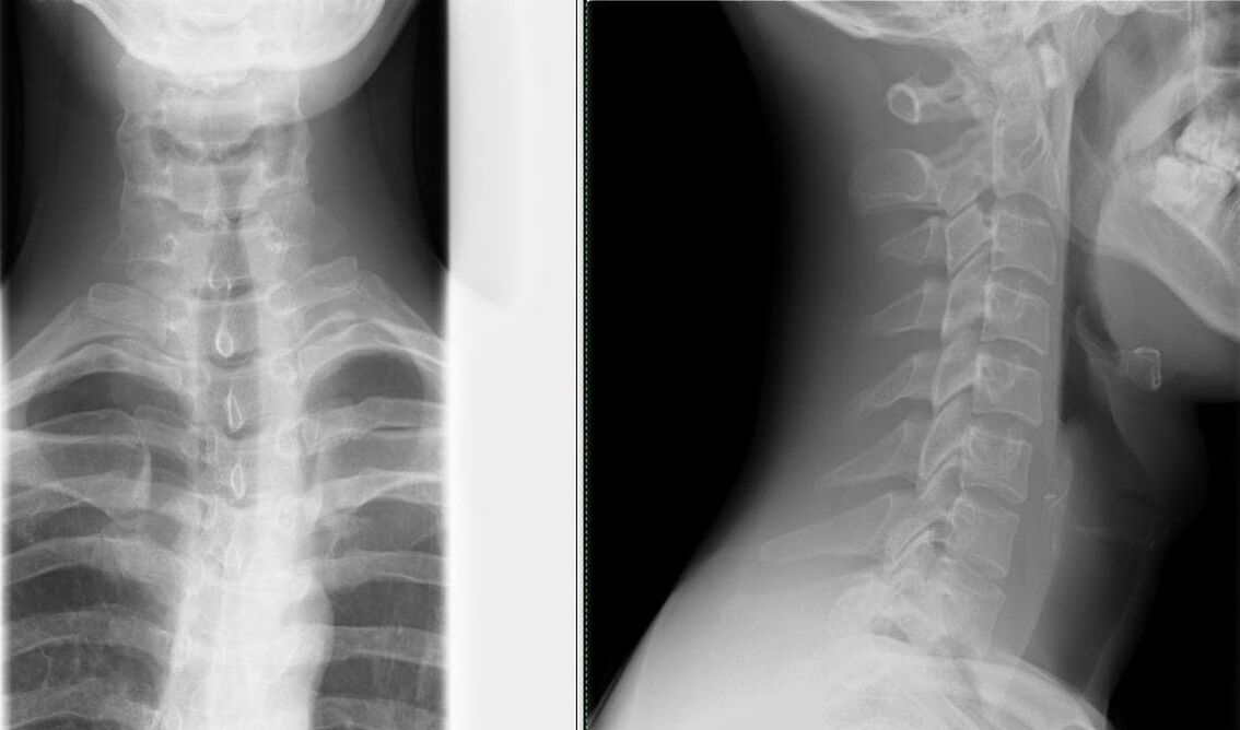 Spinal x-ray is a simple and effective method of diagnosing osteochondrosis