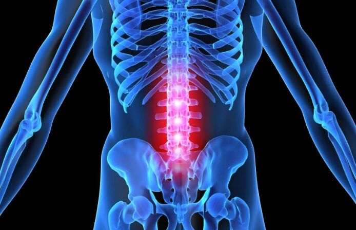 Osteochondrosis of the lumbar region