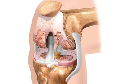 Damage to the arthrosis of the knee joint
