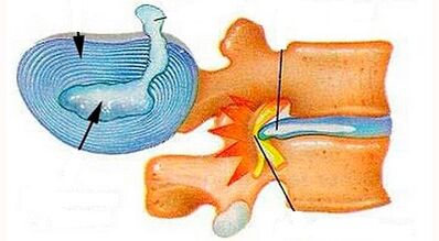 Characteristics of the development of cervical osteochondosis