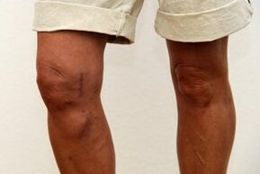 swelling of the knee joint due to osteoarthritis